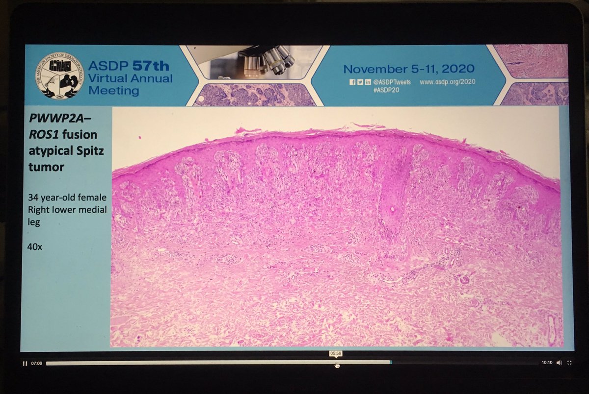 Dermpathl's tweet image. ROS1 fusion atypical Spitz tumor from a study by Pedram Gerami et al on ROS1 fusion Spitz neoplasms. 17 nevi/tumors that were identified by NGS were studied in detail and compared to 99 Spitz neoplasms without ROS1 fusion. Oral abstract at #ASDP20 #dermpath #pathology
