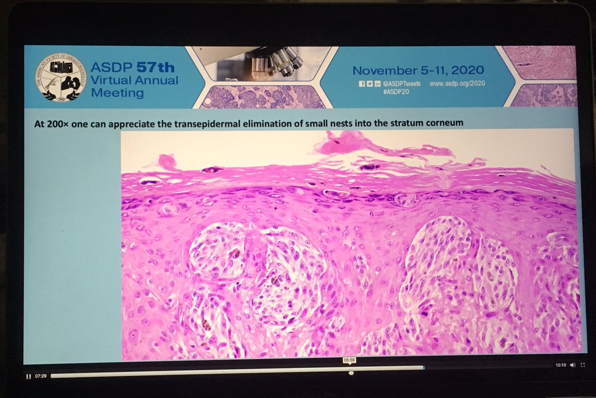 Dermpathl's tweet image. ROS1 fusion atypical Spitz tumor from a study by Pedram Gerami et al on ROS1 fusion Spitz neoplasms. 17 nevi/tumors that were identified by NGS were studied in detail and compared to 99 Spitz neoplasms without ROS1 fusion. Oral abstract at #ASDP20 #dermpath #pathology