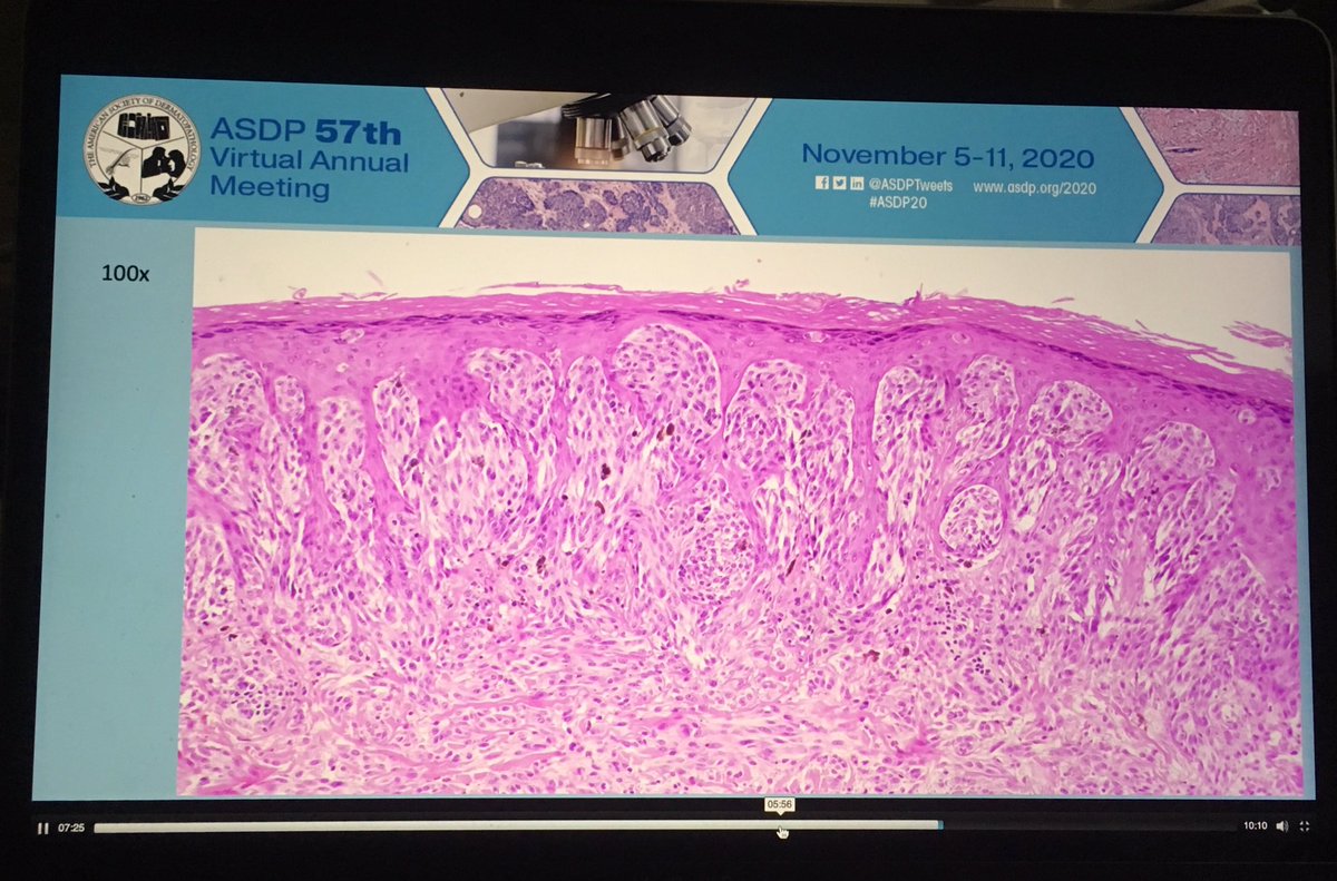 Dermpathl's tweet image. ROS1 fusion atypical Spitz tumor from a study by Pedram Gerami et al on ROS1 fusion Spitz neoplasms. 17 nevi/tumors that were identified by NGS were studied in detail and compared to 99 Spitz neoplasms without ROS1 fusion. Oral abstract at #ASDP20 #dermpath #pathology