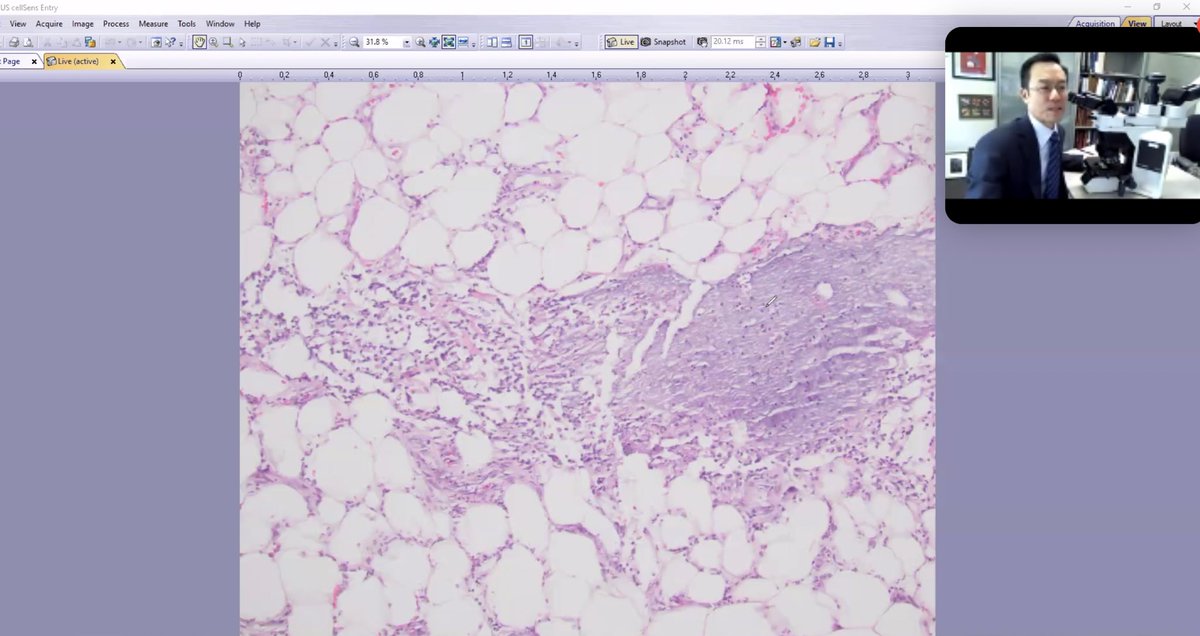 HENRYY_MD's tweet image. In early pancreatic panniculitis, you may  only see some neutrophilic infiltrates without over “saponification” type necrosis. #dermpath #ASDP2020