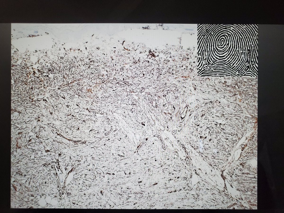 DrSarahDerm's tweet image. CD34 can be helpful in the DDx of large neurofibroma vs desmoplastic MM. CD34 is + in a whorled fingerprint pattern in NF but is essentially neg in desmo MM (of course, both are S100+, and NF1 is the most frequent mutation in desmo MM). @ASDPTweets #ASDP20 #asdp2020 #melanoma