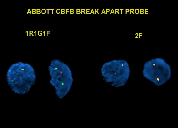 (1/3) AML with CBFB rearrangement, but there is more to this case, check the thread below for a surprise⬇️

#hemepath @LeukemiaMDA #PathTwitter