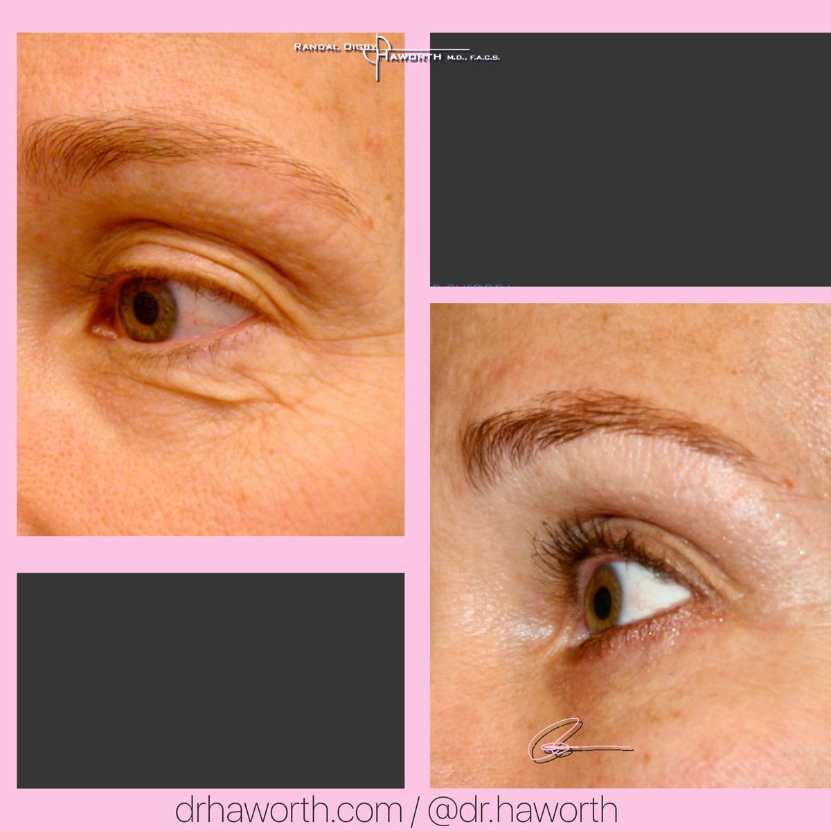 Rejuvenating the lower eye consists of 3 things:
1.  Addressing excess, crêpey skin
2. Addressing any protruding fat bags (I never remove them all, I only give them an “haircut“)
3. Addressing the dark circles under eye hollows, also known lovingly as the “tear troughs“.