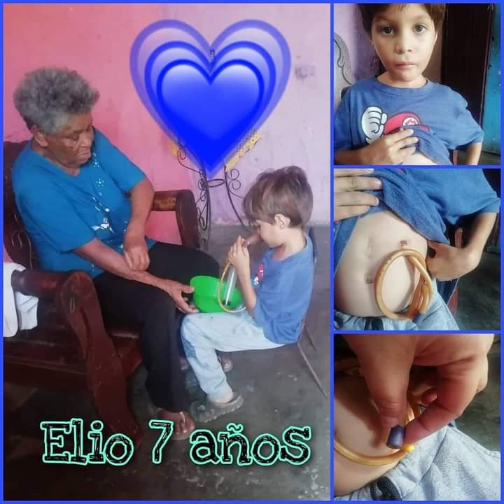 Nevuss111's tweet photo. Este niño se llama Elio, Tiene 7 años de edad, es huérfano de Padre y Madre, actualmente vive con su bisa-abuela en Guatire, edo Miranda, hacen casi 2 años por error tomó ácido que estaba en un pote y se quemó su garganta y cuerdas vocales, desde ese momento... https://t.co/mO8y3FG2bE