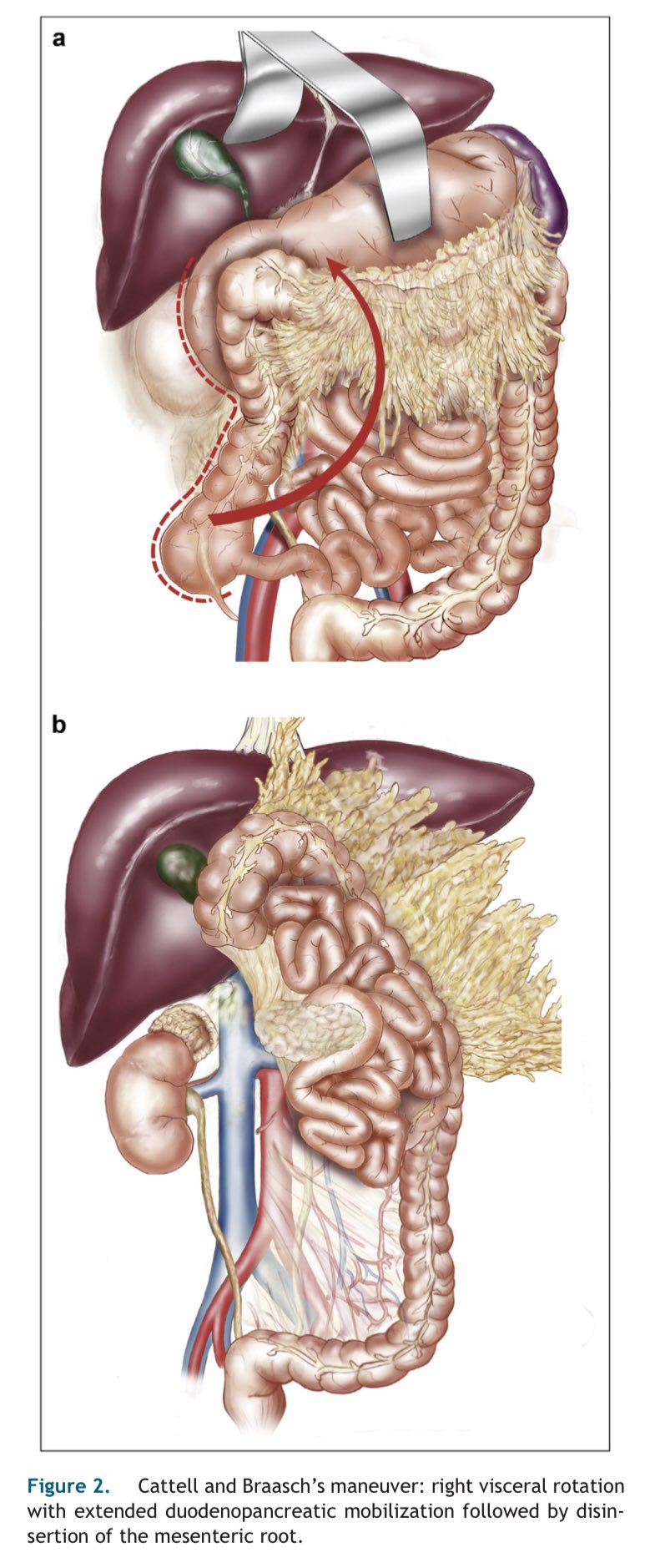Kocher Maneuver Operative Technique. A Kocher Maneuver Reveals The SMA