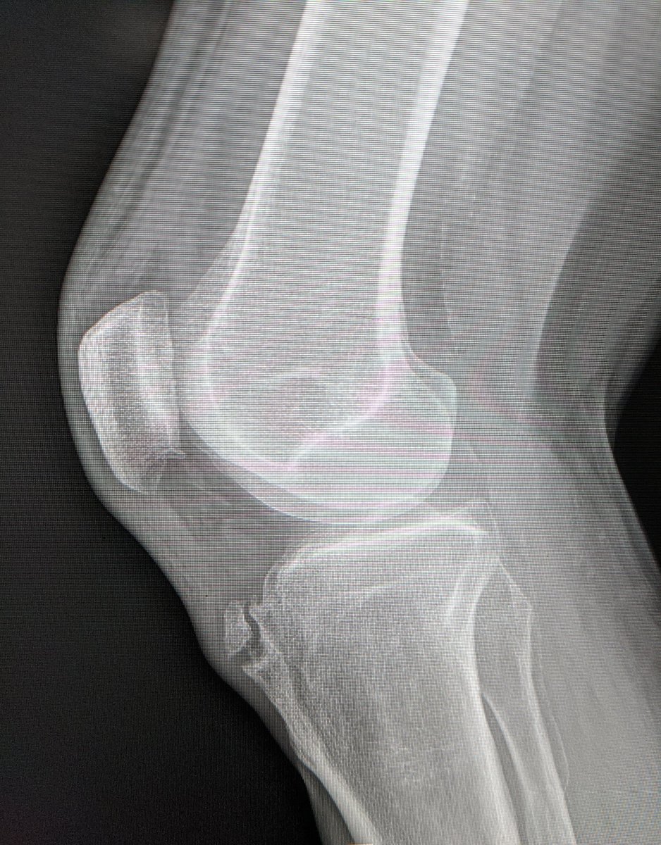 MKMSKER's tweet photo. 43 year old presenting with anterior knee pain.

Tibial tuberosity edema.
Edema across the fibrous union synchondrosis to the native tibia. Fluid in pretibial bursa.
Diagnosis: Adult presentation of Osgood Schlatter disease.
#FOAMed #MSKrad #sportsmedicine https://t.co/fhBXtjC7eh