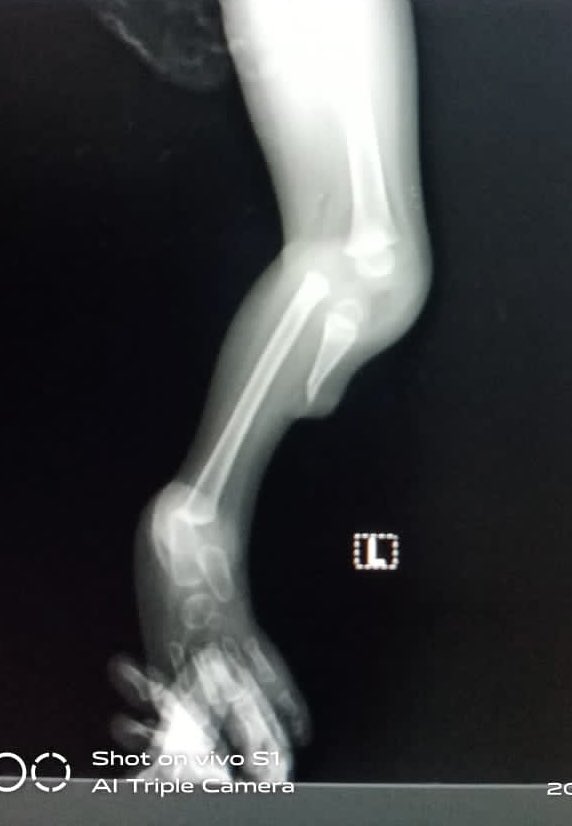 GRadiologists's tweet photo. Bilateral hemimelia. Dr Sarkodie #IDOR2020 https://t.co/oCJA4BTUVm