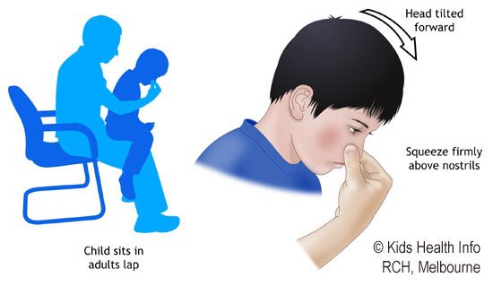 OurFavOnlineDoc's tweet photo. First Aid for Nosebleed:
•DO NOT PANIC.
Most nosebleeds are NOT serious.
•Sit/stand upright (do NOT lie down)
•Pinch tight the soft part of your nose for 10-15 minutes.
•Breathe through your mouth.
•Lean head forward. NOT backward.
•Put icepack at top of your nose.

RT pls. https://t.co/nkN6E5luKg