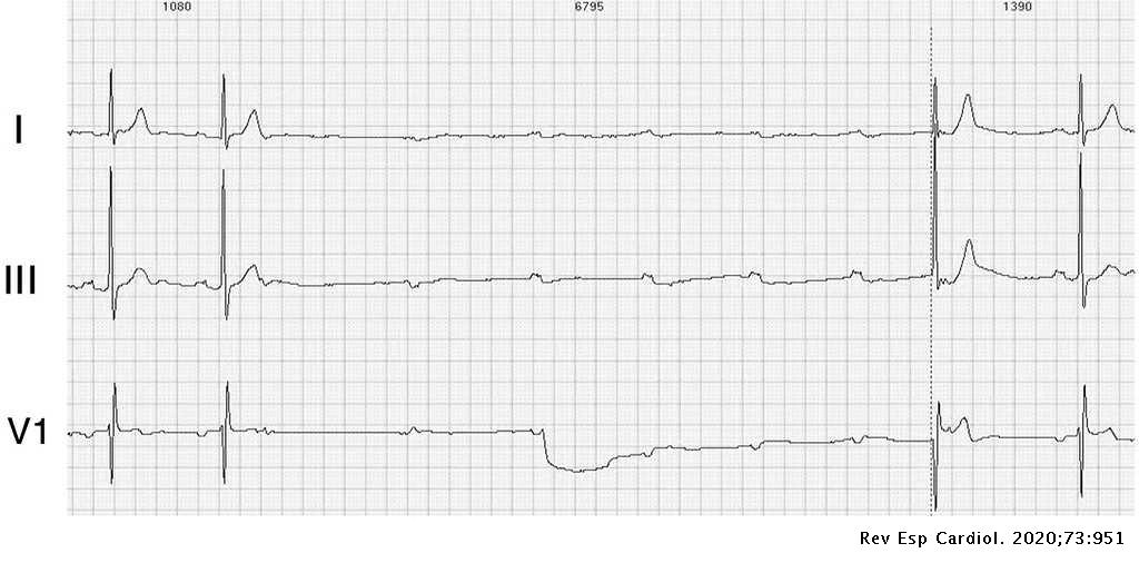 RevEspCardiol's tweet photo. ¿Te animas a participar este mes en el #RetoECG de Revista Española de Cardiología?
#REC
1) Hipertonía vagal.
2) BAV paroxístico de fase 4.
3) Bloqueo seudo-AV debido a extrasístoles nodulares ocultas.
4) BAV paroxístico de fase 3.
https://t.co/BOyg03nX76 https://t.co/8kwGW91Jt4