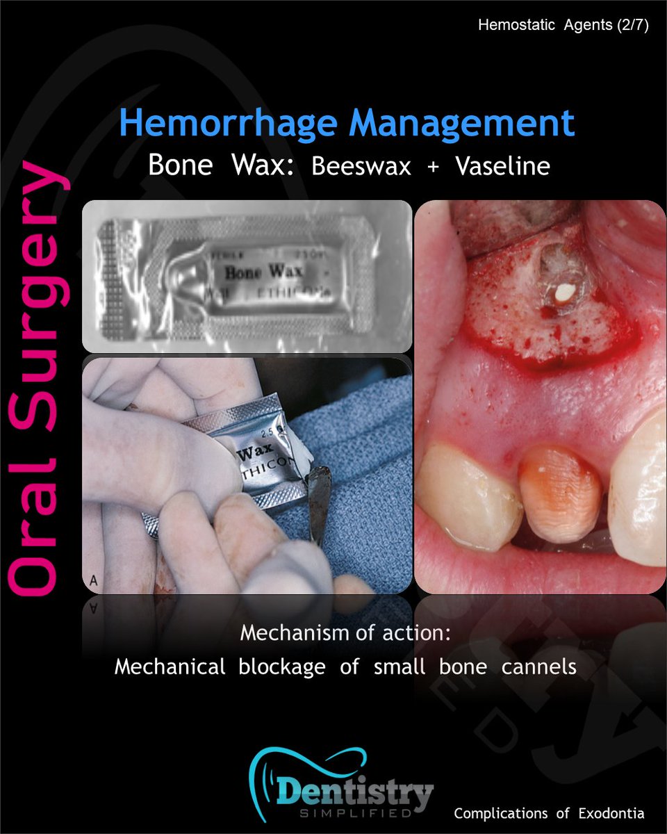 Dent_Simplified's tweet photo. Hemorrhage management: Beeswax +Vaseline

#Dentistrty #Oral_Health #mds #dds #mdsprep  #mdspreparation  #next_exam #bds  #dental #dentistry #dentists #dentalstudent #dentalcare #nbe #neet_dental #Endodontics #Endo #oralmedicine #medicine #oralsurgery #OMFS #nbde https://t.co/5BY1ABFUsg