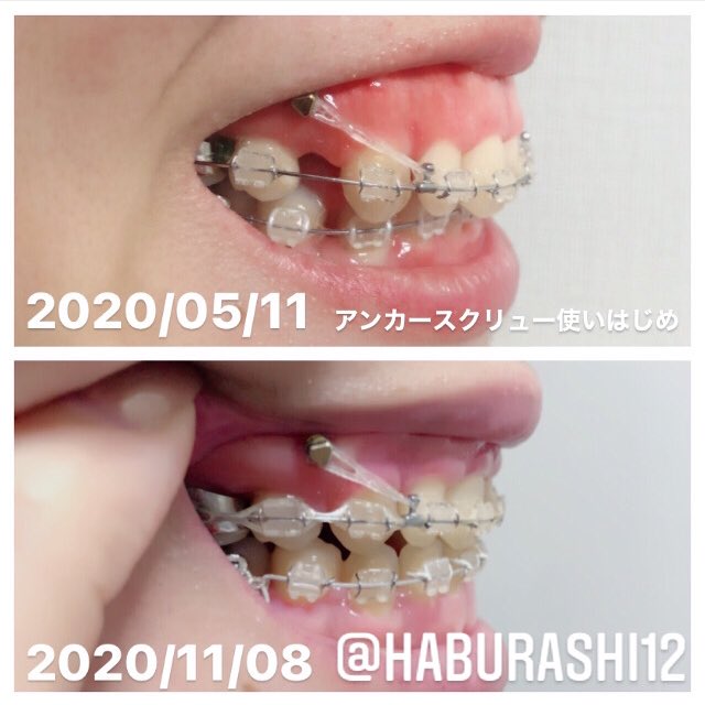 Haburashi 歯列矯正アンカースクリュー使ってからの歯の変化 横から見てもこんなに変わった 横顔も変わった 本当にワイヤー矯正でアンカースクリューやって良かった 歯列矯正 口ゴボ ガミースマイル アンカースクリュー T Co Onvn5mhg4w Haburashi 歯列矯正アンカースクリュー使ってからの歯の変化 横から見てもこんなに変わった 横顔も変わった 本当にワイヤー矯正でアンカースクリューやって良かった 歯列矯正 口ゴボ ガミースマイル アンカースクリュー T Co Onvn5mhg4w