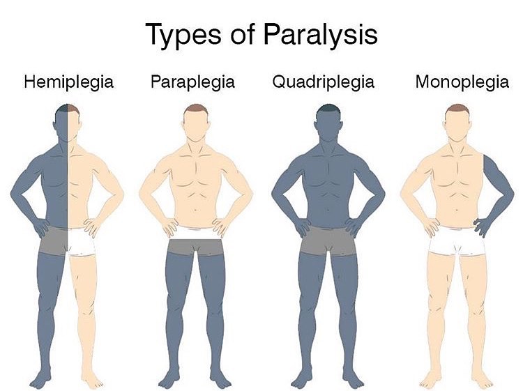Four common types of paralysis

• Hemiplegia
• Paraplegia
• Quadriplegia
• Monoplegia