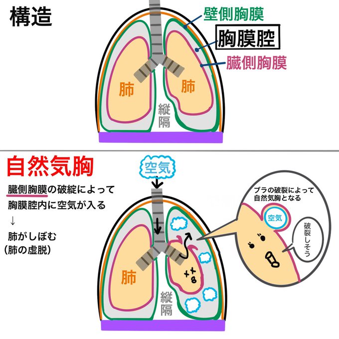 気胸のtwitterイラスト検索結果