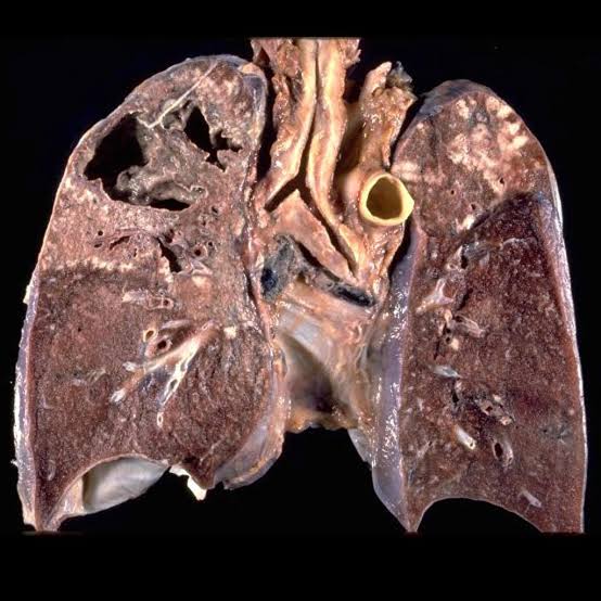 CPheyane's tweet photo. Cavitating pulmonary tuberculosis (gross pathology)

Patient that is infected by mycobacterium tuberculosis😢😢😢😢 https://t.co/qJ0ff08p6F