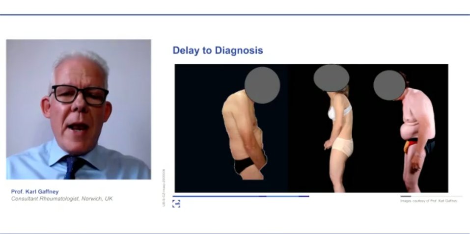 Dr. Karl Gaffney on the impact of the delay to diagnosis in  #axSpA  #ACR20