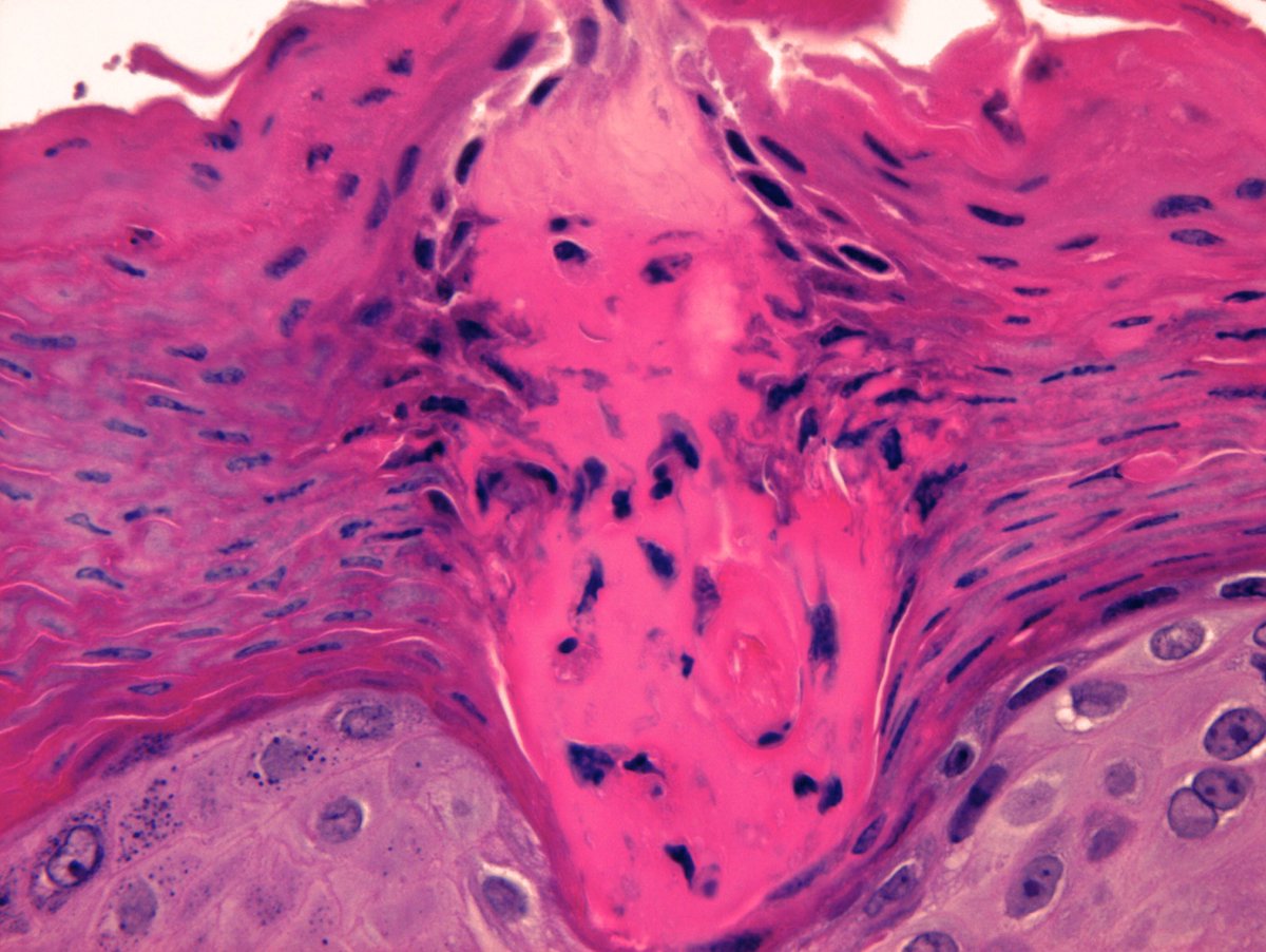 A smiling boy in porokeratosis