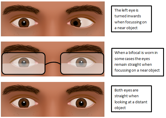 O Xrhsths Amblyoplay Sto Twitter Intermittent Esotropia Is A Type Of Squint When An Individual Is Looking Beyond 3m No Squint Can Be Seen The Squint Is Only Seen When Focusing On