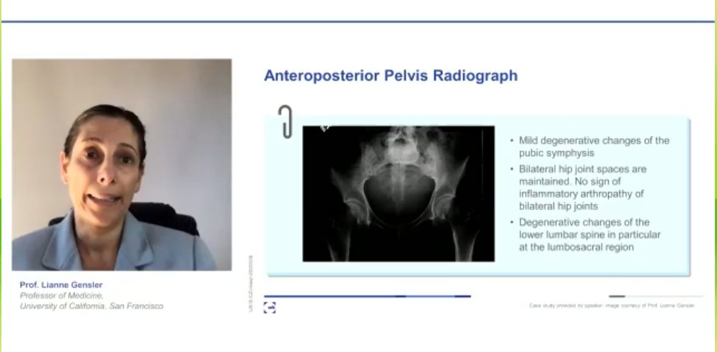 XR: no jt space narrowing or ankylosis of the SI jointsBUT, erosive sacroiliitis without bone marrow edema seen on the MRI Diagnosis:  #axSpA (OR could consider psoriatic spondylitis vs axial PsA)  #ACR20