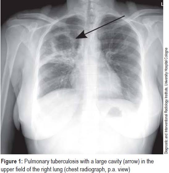 CPheyane's tweet photo. X-ray viewing mycobacterium tuberculosis⛔ https://t.co/6zsJQq1fcY