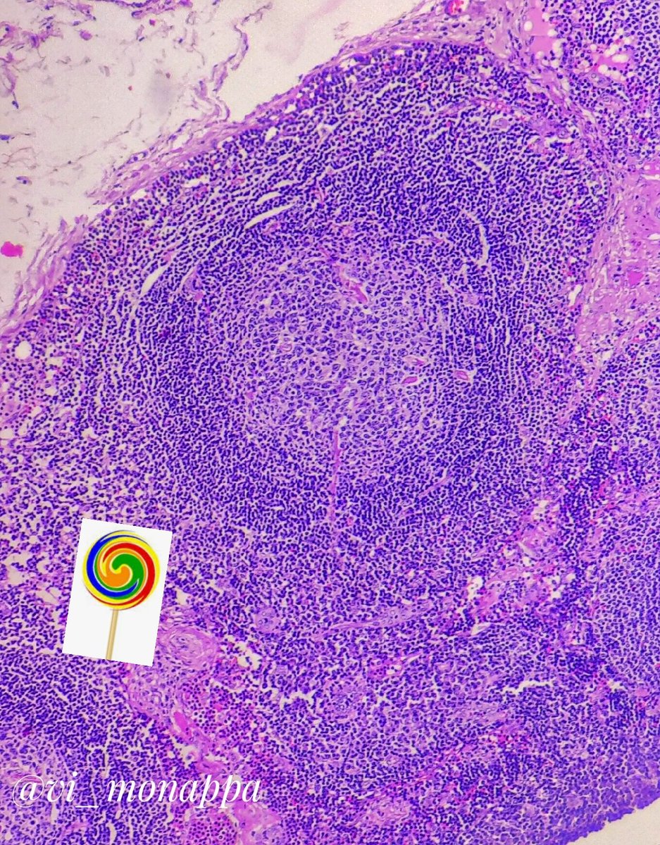vi_monappa's tweet photo. #hemepath #LNPath
🍭 follicle... Seen in Castleman disease HV variant. https://t.co/y7xaBI6CtI