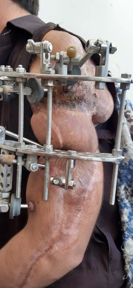 IrfanZehri100's tweet photo. تحصیل زہری کے رہائشی عبدالوحید جن کے ہاتھ کو ایک سال پہلے بجلی کی شارٹ لگنے سے ان کے ہاتھ پوری طرح متاثر ہوا پھر وہ اپنی حیثیت کےمطابق بہت علاج کروائے راڈ بھی لگوایا ہے ایک سال سے زیادہ گزرنے کے بعد بھی ہاتھ کے ہڈیاں جڑھ نہیں رہی ہے اب مزید علاج کی سکت بھی نہیں رکھتے.
03361868148 https://t.co/hBCz0AIVtw