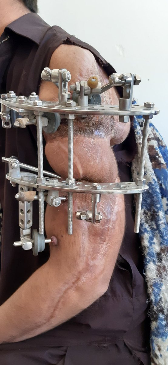 IrfanZehri100's tweet photo. تحصیل زہری کے رہائشی عبدالوحید جن کے ہاتھ کو ایک سال پہلے بجلی کی شارٹ لگنے سے ان کے ہاتھ پوری طرح متاثر ہوا پھر وہ اپنی حیثیت کےمطابق بہت علاج کروائے راڈ بھی لگوایا ہے ایک سال سے زیادہ گزرنے کے بعد بھی ہاتھ کے ہڈیاں جڑھ نہیں رہی ہے اب مزید علاج کی سکت بھی نہیں رکھتے.
03361868148 https://t.co/hBCz0AIVtw