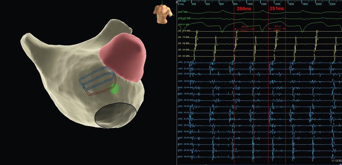 murphy_lzy's tweet photo. Post MV repair pt, will you conclude it is critical for the tachy?
#AbbottEmp #EPeeps @EricTSLim @JeffZhanghk2017 @Mya49099911 @sabarisarav @Hapa_EP @forkknifecab_EP @szufski1 @ep_nerd @AbbottCardio https://t.co/UTYc7WB6x9