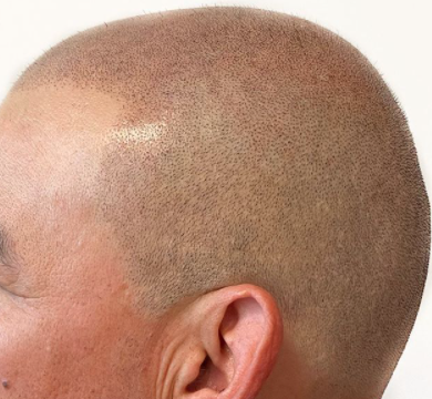 GoRestorink's tweet image. Would you look at this picture perfect scalp?! This client was able to restore his natural hairline using our non-surgical, semi-permanent micropigmentation solution. You’re up! #hairhealth #micropigmentation #scalppigmentation