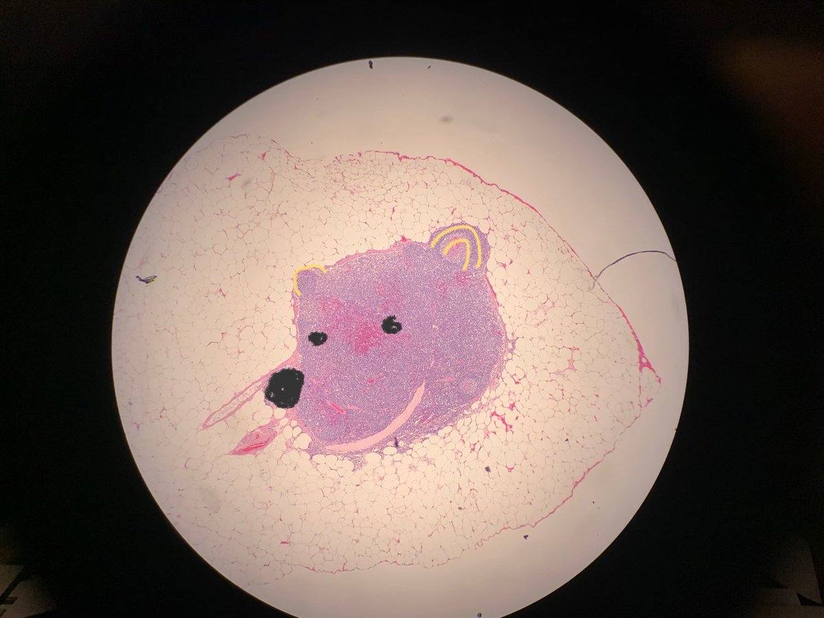 PathologyRWJMS's tweet photo. Winnie the Pooh spotted in a lymph node! @fiftydollarbil https://t.co/C58DoyA8Vy