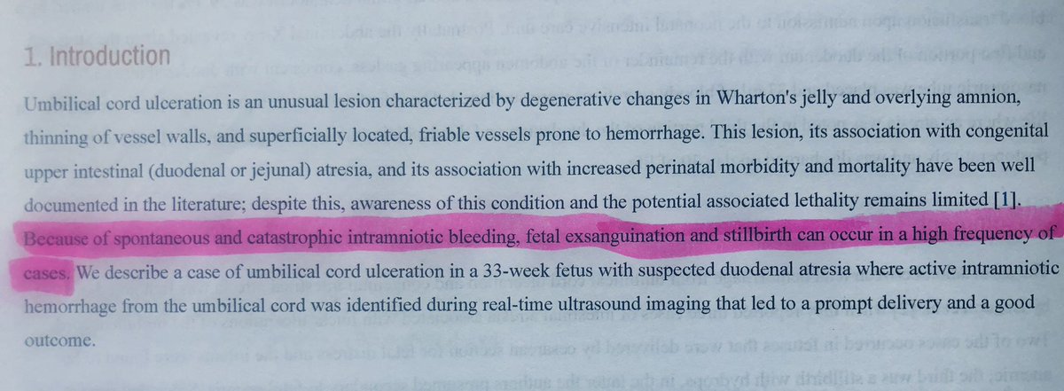jcollinsmd77's tweet photo. OB Facts: Prenatal diagnosis of a UCA with prevention of stillbirth. An Umbilical cord pathology which can cause death if ignored. Request a pathology review of any UCA noted at delivery. https://t.co/TQYAotMPK6