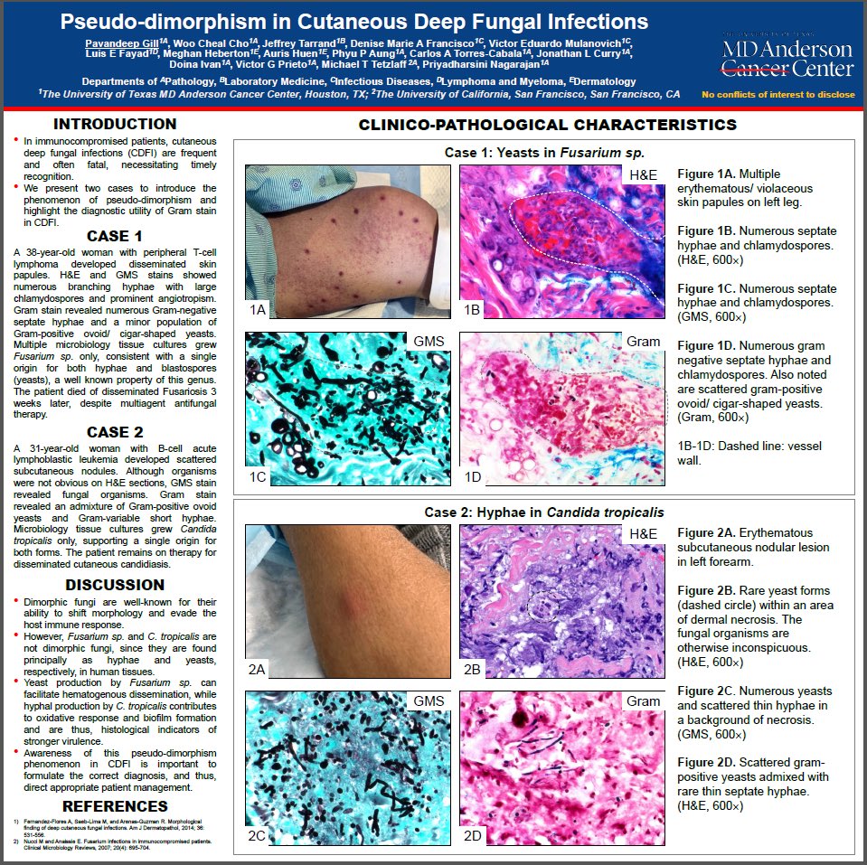DrAldehyde's tweet image. Happy Monday. Here are 4 representative interesting (at least to me 😁) posters from MDACC being presented at #ASDP20 this year! Check them out! #ASDP2020 #dermpath #IDPath #hemepath
