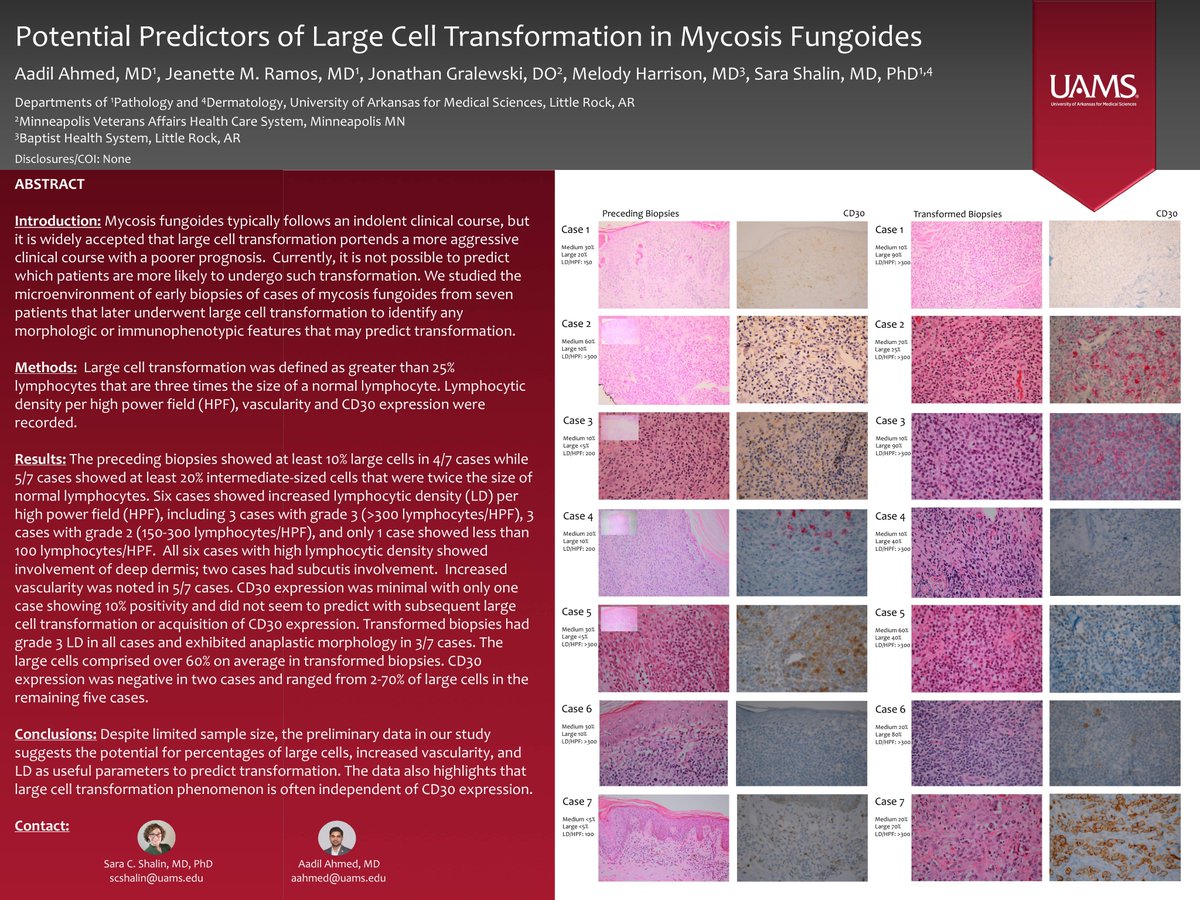 AadilAhmedMD's tweet image. Size matters!! Our preliminary study suggested large size and high lymphocytic density in the preceding biopsy as predictors of large cell transformation in mycosis fungoides #ASDP2020