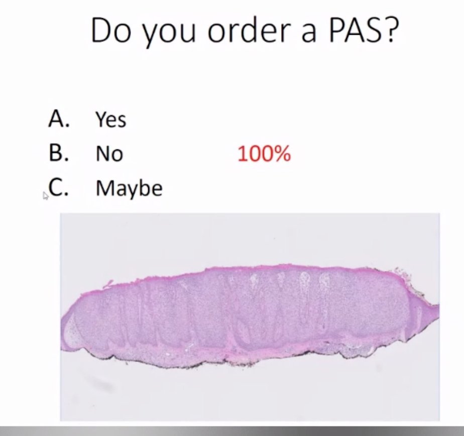 FungMaxwell's tweet image. APPROPRIATE USE: Would you order a PAS stain for this clear cell acanthoma? The #dermpath "Supreme Court" (for #ASDP20 Common Quandries Short Course) rendered their Opinion over the weekend: "NO" @ASDPTweets