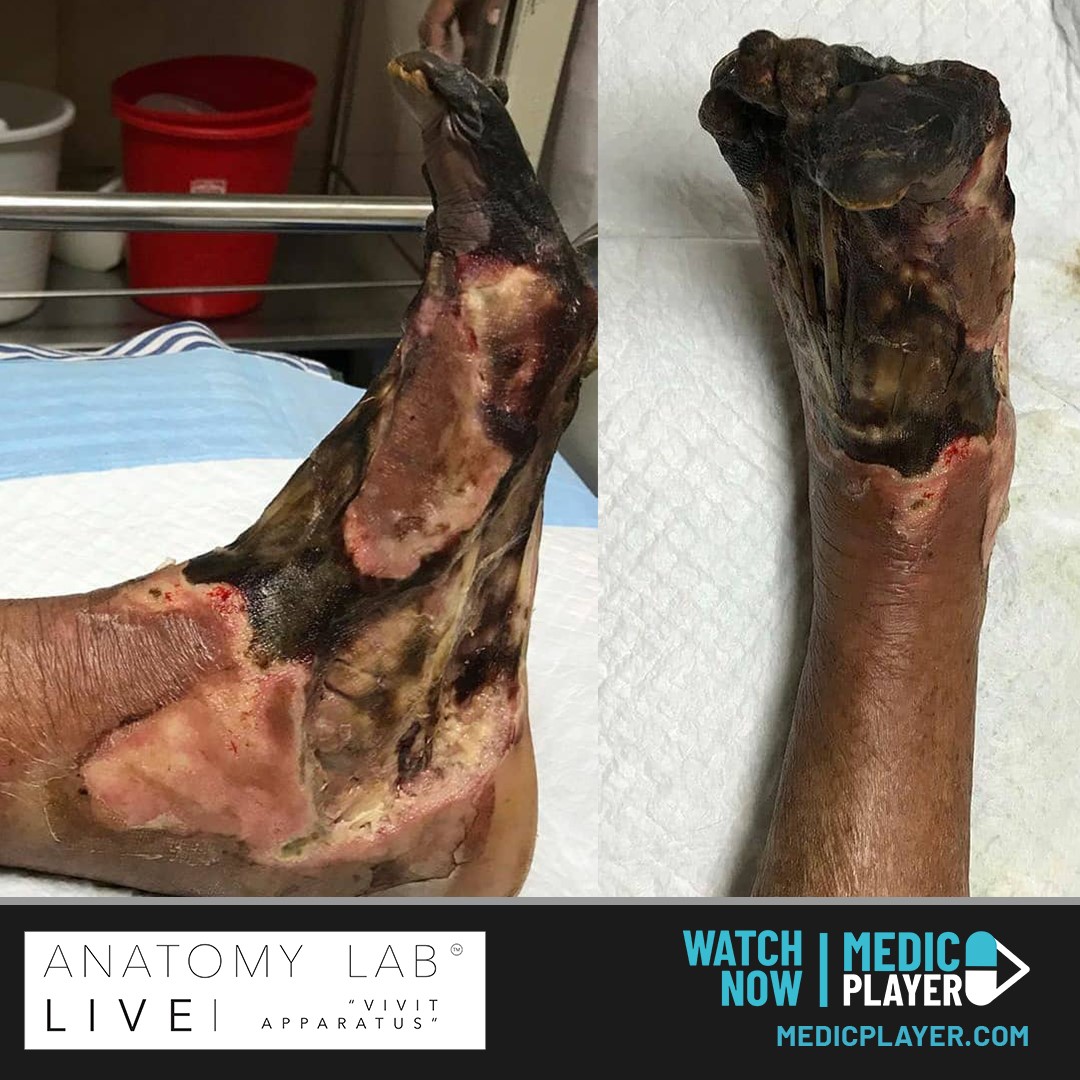 The results of a untreated diabetic foot ulcer.. 

When blood sugar levels are high or fluctuate regularly skin that would normally heal may not properly repair itself because of nerve damage.

Even a mild injury can start a foot ulcer.

WATCH NOW ▶️ medicplayer.com