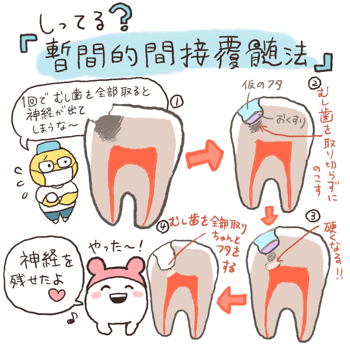 歯を健康で長持ちさせるには、なるべく神経を取らない方がいいんだ。
神経を取るかどうか微妙な大きさの虫歯には、「暫間的間接覆髄法」という方法があるよ。治療が完了するまで数回かかるけど、神経を残せることがあるんだ。
ただし、痛みが出てしまった歯や大きすぎる虫歯にはこの方法は使えません😭
