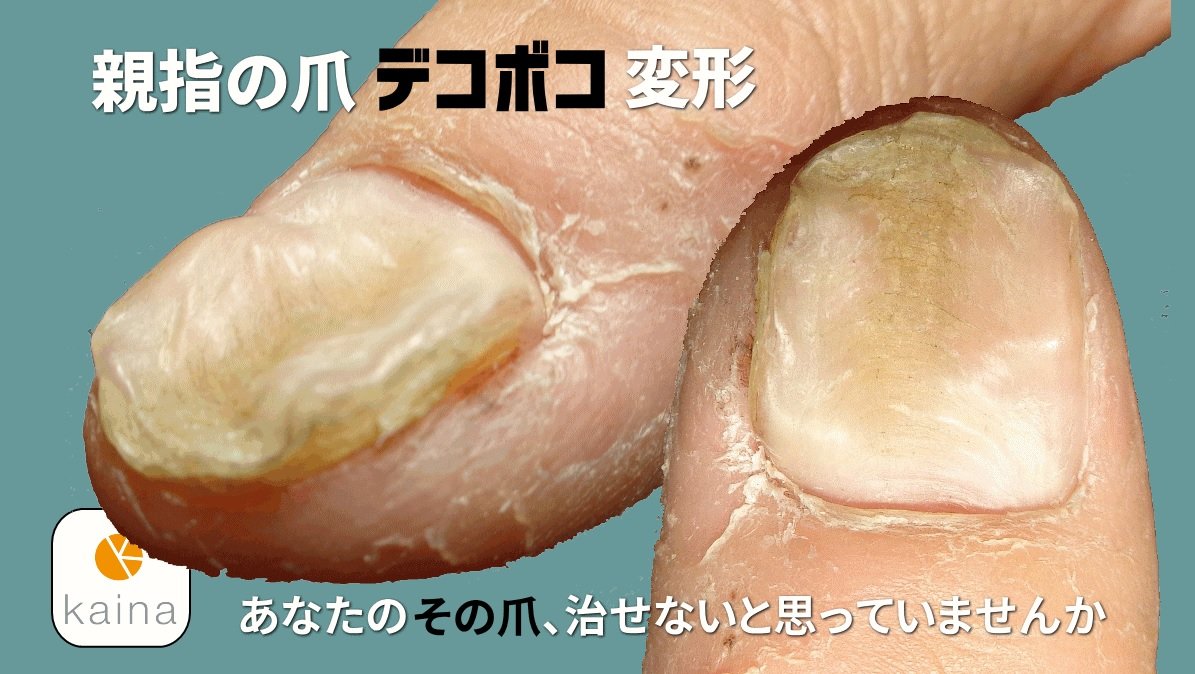 自爪は強くなる 療爪 Kaina プロのギタリストもご愛用 デコボコ爪は一度なってしまうと治らないんじゃないか いえ それは違います ご購入の際に無料でメールカウンセリング ご相談できますよ でこぼこ爪 ぼこぼこ爪 深爪矯正 自爪は強くなる 療爪 Kaina プロのギタリストもご愛用 デコボコ爪は一度なってしまうと治らないんじゃないか いえ それは違います ご購入の際に無料でメールカウンセリング ご相談できますよ でこぼこ爪 ぼこぼこ爪 深爪矯正