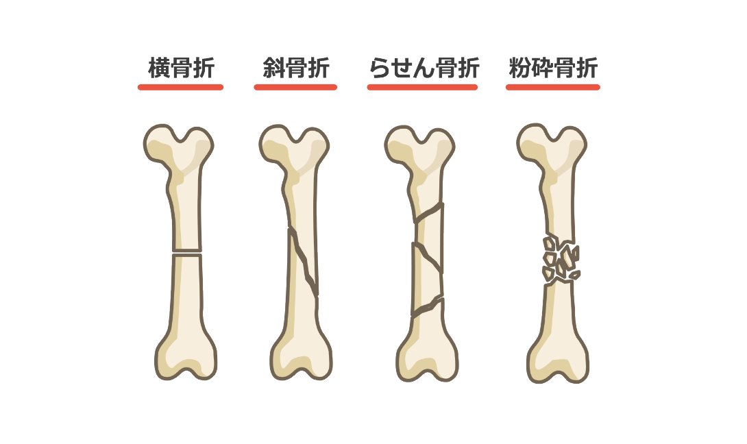 Twitter 上的 看護roo 公式 かんごるー 主な骨折の種類がわかるイラストってないかな W あるよ 横骨折 斜骨折 らせん骨折 粉砕骨折 フリー素材 フリーイラスト 作 Kangoshi Illust 看護師 イラスト集 横骨折 斜骨折