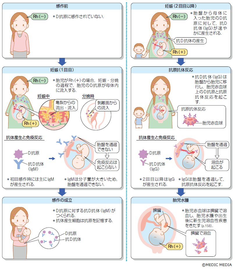 病気がみえる Rh式血液型不適合妊娠 血液型がrh の妊婦がrh の胎児を妊娠した場合に生じる 1回目の妊娠 で母体が胎児のd抗原に感作され 2回目の妊娠時に母体の抗d抗体が胎盤を通じて胎児に移行し 胎児貧血などを引き起こす 病みえ10p 157