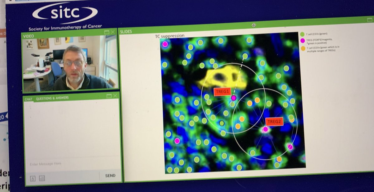 BernardAFox's tweet photo. 💥SEE THIS INFO #DCIS/ Prof Borowsky @ucdavis #multiplexIHC for new DCIS classification/which DCIS go to #breastcancer ? #BreastCancerAwareness @TNBCFoundation @LivingBeyondBC @BreastCancerAw7 @KomenOregon #immunotherapy /#SITC2020 @AkoyaBio @Ultivue @HalioDx #JEDICouncil #TNBC https://t.co/GfHDLxWG2P