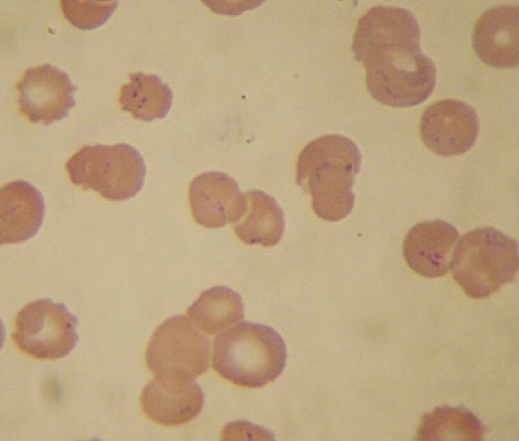 #idboardreview 20 M from Peru 7d of fever, dyspnea, jaundice now w/ altered mental status. Hb4, plt250, ast34, ALT200, Tbili4, cxr b/l infiltrates. Diagnosis? #medEd #idmedEd