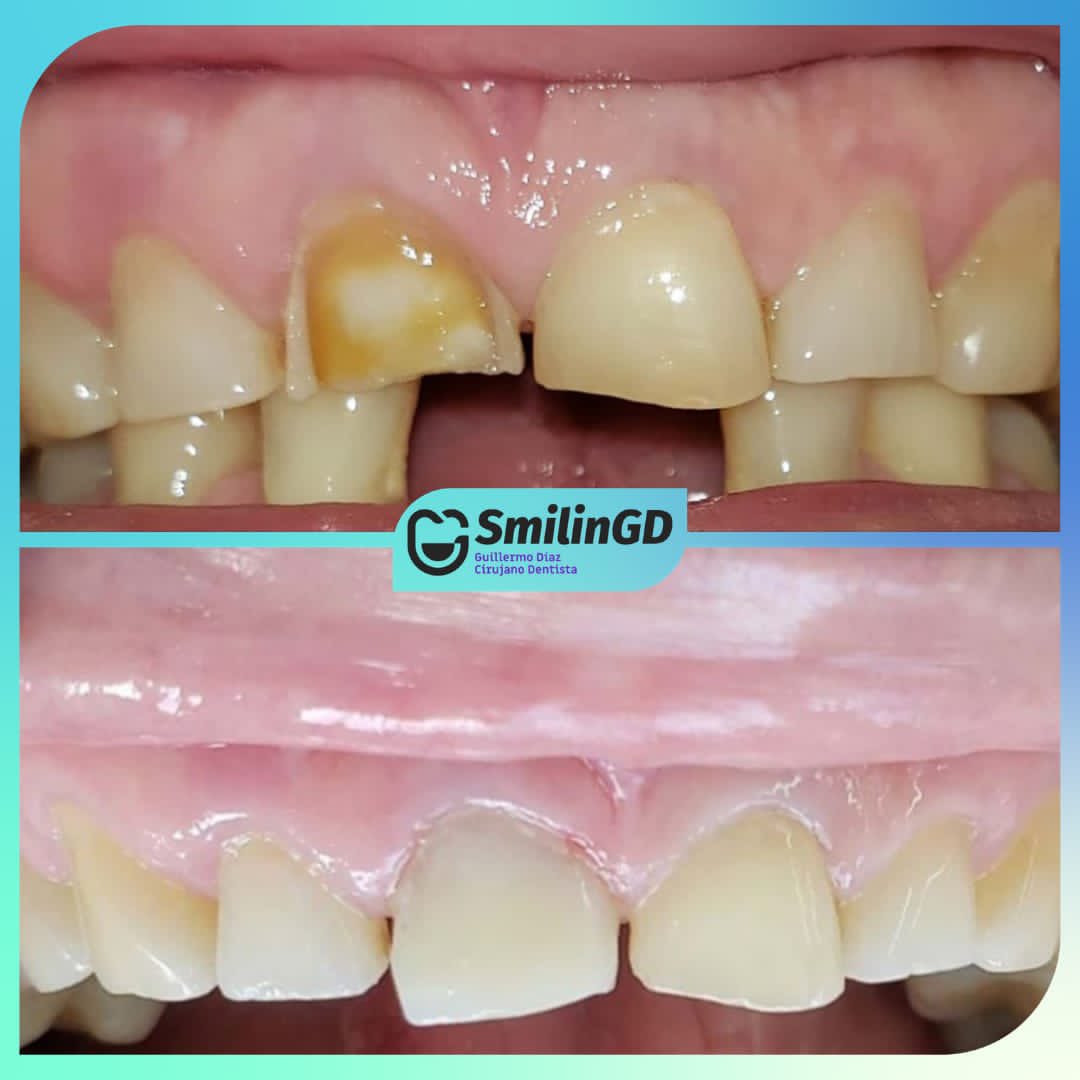 SmilinGD_'s tweet photo. ¿Sabes que son las carillas ?🤔👇🏼
Son pequeñas láminas delgadas que sirven como cubiertas de tus dientes, dándoles un aspecto totalmente natural y estético. 
Pueden realizarse de distintos tipos de materiales y con distintas técnicas.
.
.
.
 #smilingd #beforeandafter #odontologo https://t.co/CQvGW9xryI