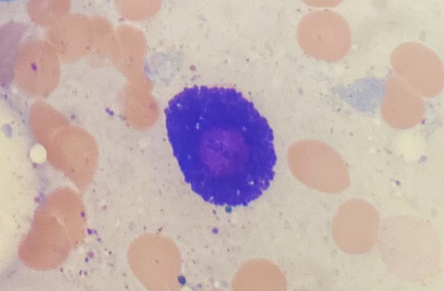 This cell is usually difficult to see because it is hidden within bone marrow spicules. But once in a while, it is out in the open. What is this cell? 
📸by <a href="/AlessaAragaoMD/">Alessa Aragao, MD</a>