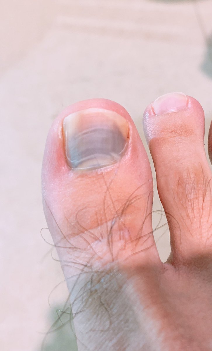 げんちゃん 内出血ひどい お大事に