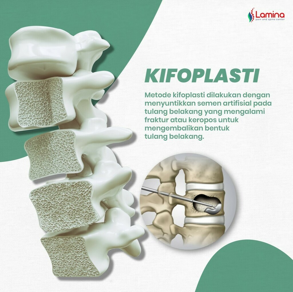 KlinikLamina's tweet photo. Kifoplasti

Metode kifoplasti dilakukan dengan menyuntikkan semen artifisial pada tulang belakang yang mengalami fraktur atau keropos untuk mengembalikan bentuk tulang belakang.
.
.
#kifoplasti #keropostulang #osteoporosis #tulangbelakang https://t.co/MsB7y0IHvB