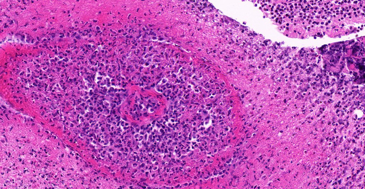 TristanRutland7's tweet photo. Brain, Adult male, polycystic kidney disease

@ZHOUSEH @MattieFarzin @pembeoltulu @ariella8 @Divya_Madhala @Kashifhazim @Meghna0630 @DrGeeONE @Venkateshgilly2 @BrainsSlicer @DrBMcGinn @JMGardnerMD @Patholwalker @MAHoureih @Teclis82 @DrMarkOng 

#NeuroPath #pathtwitter #pathology https://t.co/OPUZSkJ4PI