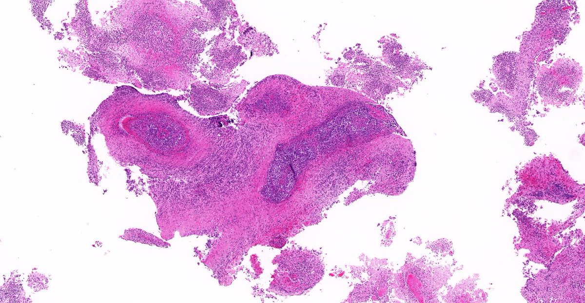 TristanRutland7's tweet photo. Brain, Adult male, polycystic kidney disease

@ZHOUSEH @MattieFarzin @pembeoltulu @ariella8 @Divya_Madhala @Kashifhazim @Meghna0630 @DrGeeONE @Venkateshgilly2 @BrainsSlicer @DrBMcGinn @JMGardnerMD @Patholwalker @MAHoureih @Teclis82 @DrMarkOng 

#NeuroPath #pathtwitter #pathology https://t.co/OPUZSkJ4PI