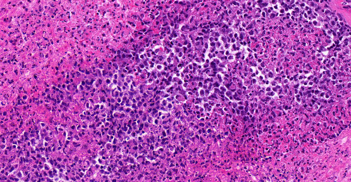 TristanRutland7's tweet photo. Brain, Adult male, polycystic kidney disease

@ZHOUSEH @MattieFarzin @pembeoltulu @ariella8 @Divya_Madhala @Kashifhazim @Meghna0630 @DrGeeONE @Venkateshgilly2 @BrainsSlicer @DrBMcGinn @JMGardnerMD @Patholwalker @MAHoureih @Teclis82 @DrMarkOng 

#NeuroPath #pathtwitter #pathology https://t.co/OPUZSkJ4PI