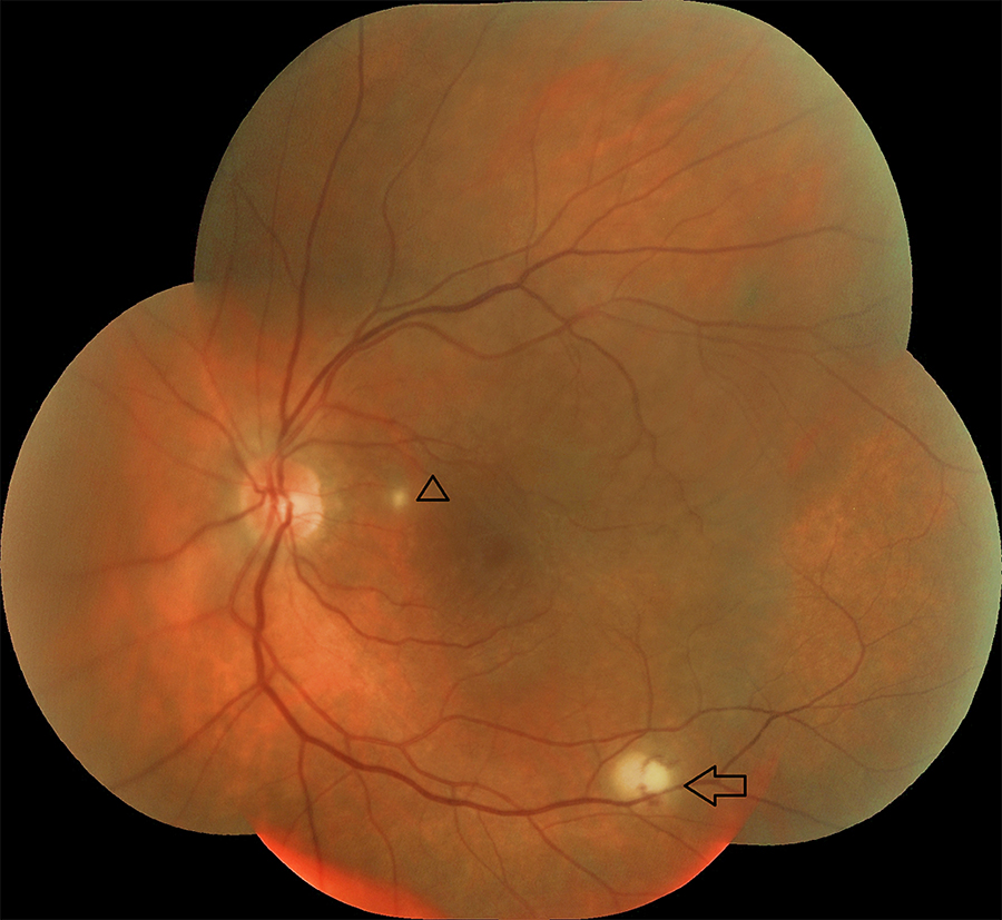 Read 👀 a new Case Report on 'Bilateral Endogenous Candida dubliniensis Endophthalmitis Treated with Aggressive Local and Systemic Therapy' at ow.ly/xw4150CfaIl #Ophthalmology #OpenAccess