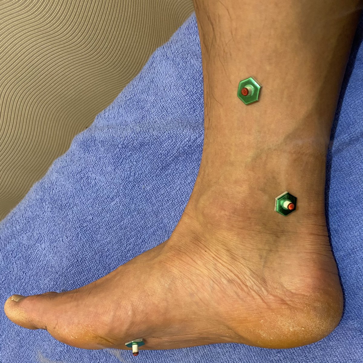 せんねん灸 ツボ むくみ