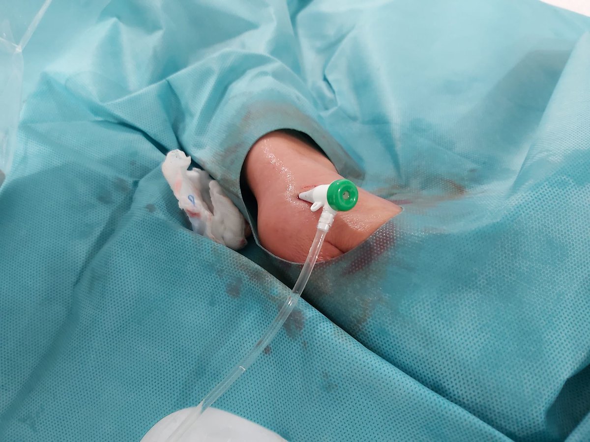 Kristian Rivera (@noreflow) on Twitter photo Our First 60 cases!!! #thinradial <a href="/ThinkRadial/">ThinkRadial</a> @ferdikiem #Ldtra <a href="/harnaulleida/">Hospital Universitari Arnau de Vilanova</a> Our First 60 cases!!! #thinradial <a href="/ThinkRadial/">ThinkRadial</a> @ferdikiem #Ldtra <a href="/harnaulleida/">Hospital Universitari Arnau de Vilanova</a>
